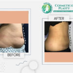 Liposuction Cost in Pakistan