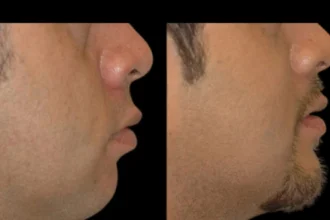 Double chin removal