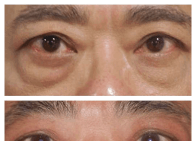 Eye Bag Removal