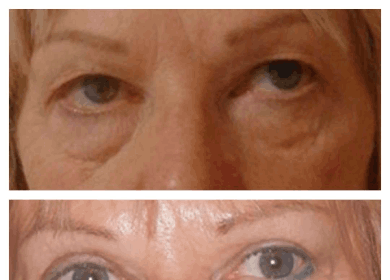 Eye Bag Removal