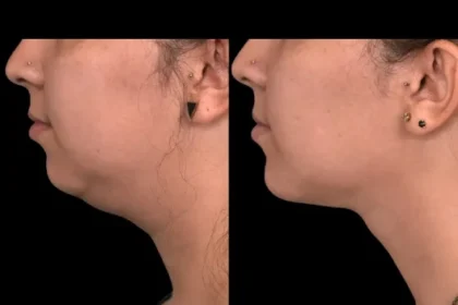 Double chin removal