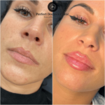 Juvederm