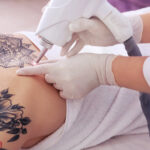 Cover-Up or Remove Best Tattoo Removal Advice