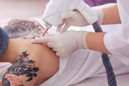 Cover-Up or Remove Best Tattoo Removal Advice