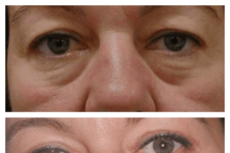 Eye Bag Removal