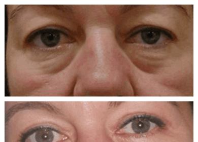 Eye Bag Removal