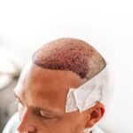 Hair Transplant in Dubai