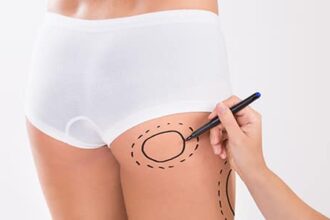 The Role of Fat Grafting in Butt Augmentation: Insights from the Best Doctors in Dubai