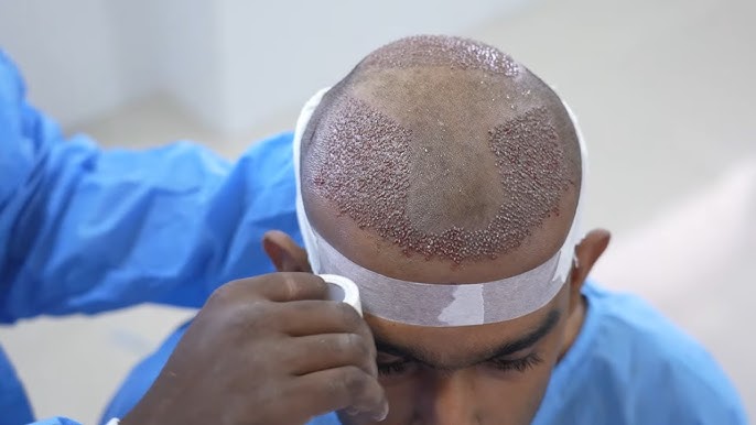 How Long Does a Hair Transplant Take to Show Results