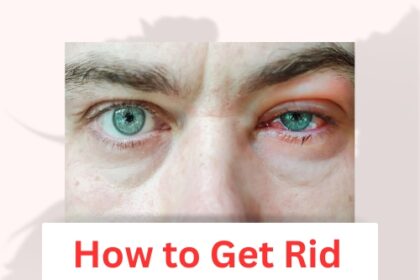 How to Get Rid of Blepharitis