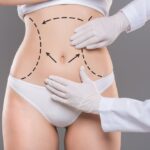 Liposuction Riyadh