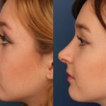 Rhinoplasty in Riyadh