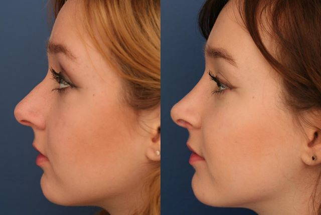 Rhinoplasty in Riyadh