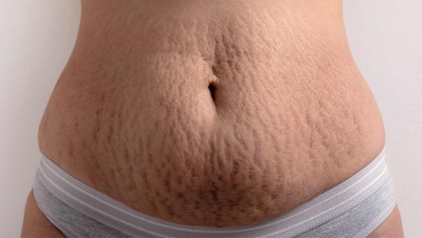 Safe and Effective Stretch Mark Reduction