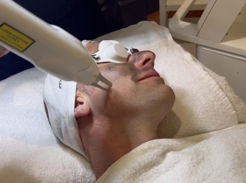 Say Goodbye to Dull Skin with Laser Carbon Peel