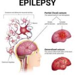 epilepsy