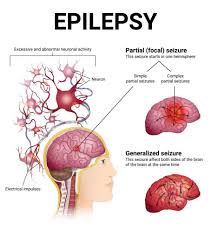 epilepsy