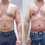 Best Gynecomastia Surgeon in Dubai