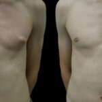 Best Gynecomastia Surgeons in Dubai