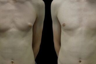 Best Gynecomastia Surgeons in Dubai