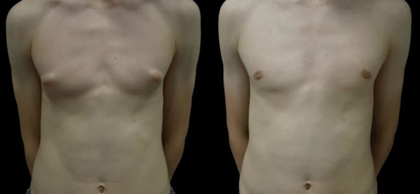 Best Gynecomastia Surgeons in Dubai