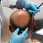 Why Crown Hair Transplant is a Game-Changer